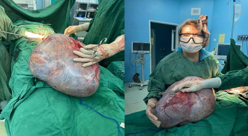 جراحی تودە شکمی ١٨ کیلویی در بیمارستان فوق تخصصی بیستون کرمانشاە