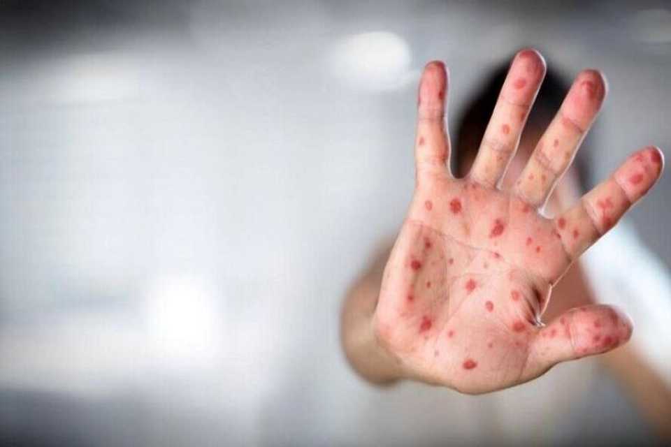 ژمارەی تووشبووانی نەخۆشی مەیموون لە ئاستی جیهان گەیشتە 35هەزار كەس